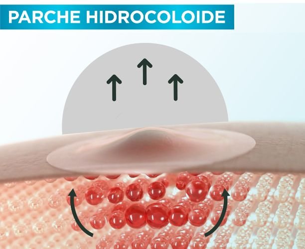 Parche para granitos